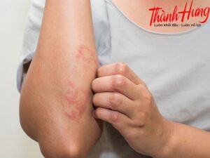 Nổi mẩn đỏ, ngứa rát.