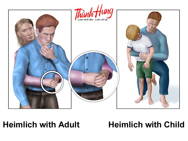 Mẹo chữa hóc xương cá bằng thao tác ép bụng, vỗ lưng giúp đẩy xương cá ra ngoài.